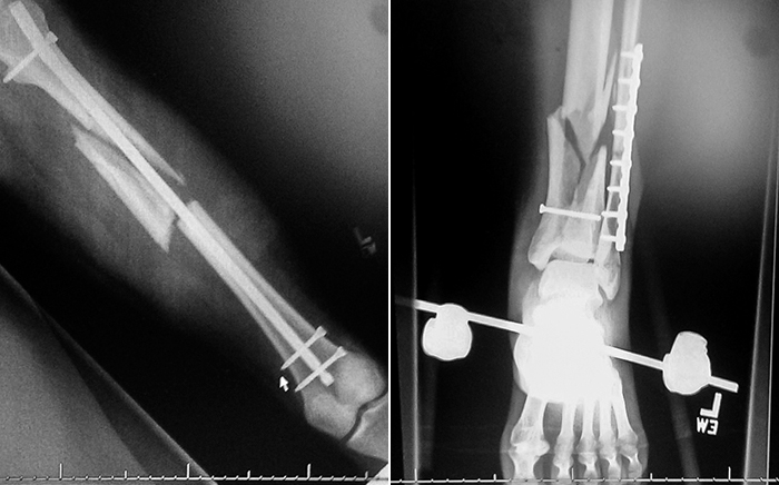 X-rays reveal Correa's xxx and xxx.