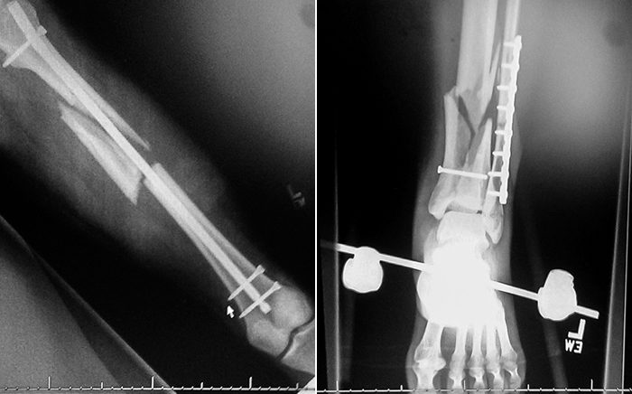 X-rays reveal Correa's xxx and xxx.